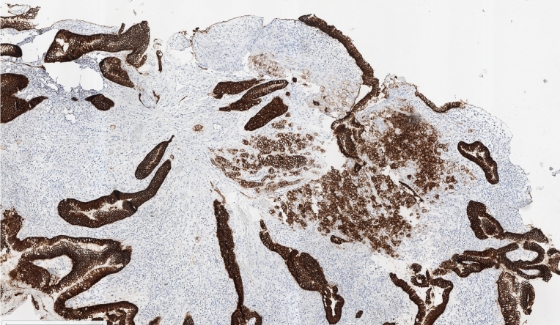 stain-gastriccancer-5x